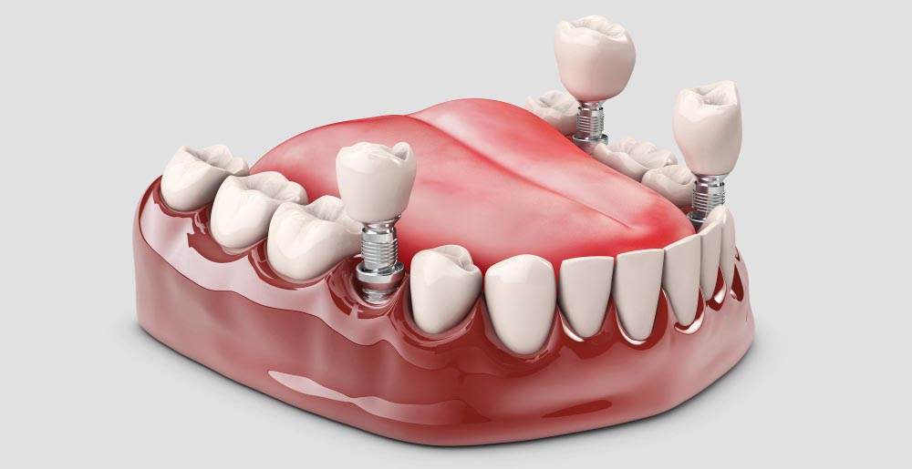 implante dentare