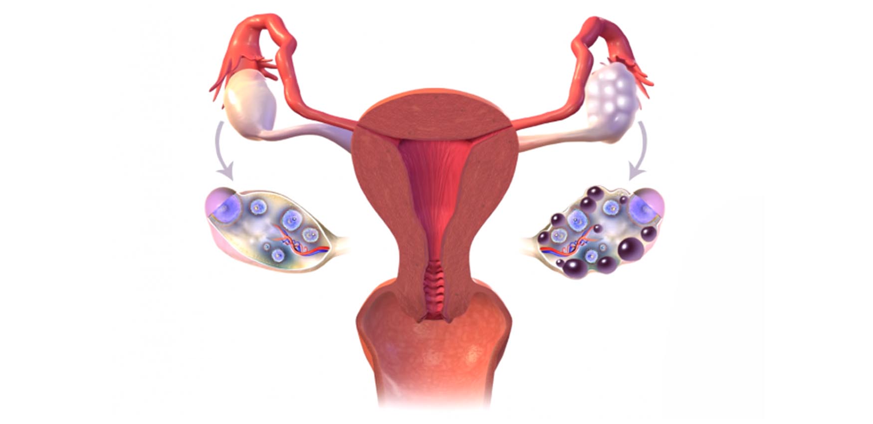 sindroma e vezore polikistike